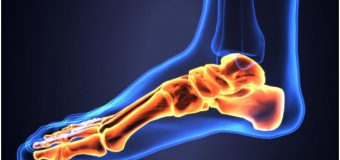 Topuk Dikeni Nedir? Nasıl Tedavi Edilir?