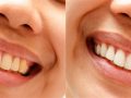 Photoshop Diş Beyazlatma İşlemi ile Bembeyaz Dişler