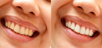 Photoshop Diş Beyazlatma İşlemi ile Bembeyaz Dişler